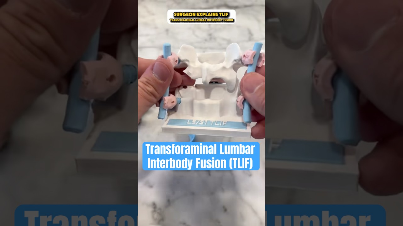 This is a TLIF (Transforaminal Lumbar Interbody Fusion)