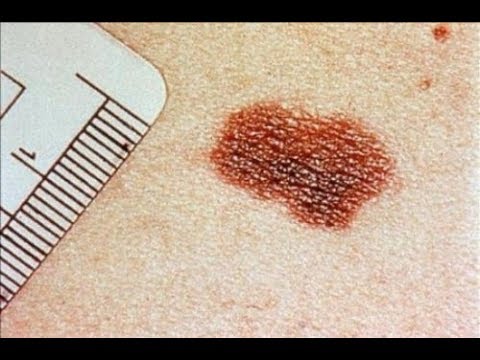 Wpadać na piechotę w pobliżu dużych maści leczniczych toe Wrodzony deformacja zatrzymania Patologia