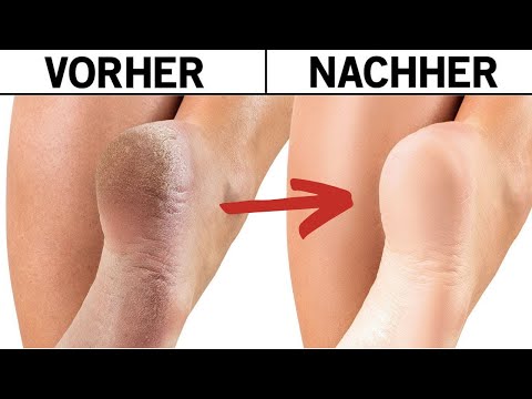 Wie du rissige Fersen mit einfachen Hausmitteln behandelst!