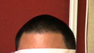preview picture of video 'Los Gatos FUE Hair Transplant California Excellent Result Before After Dr. Diep www.mhtaclinic.com'
