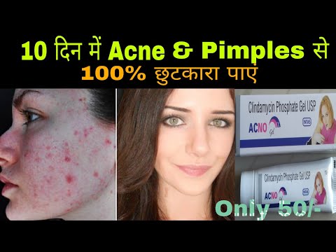 #ACNO#GEL Clindamycin Phosphate gel/10 दिन में Acne & Pimples से 100% छुटकारा पाएं / Review in hindi