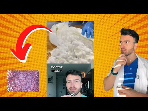 What Draining An Abscess Feels Like