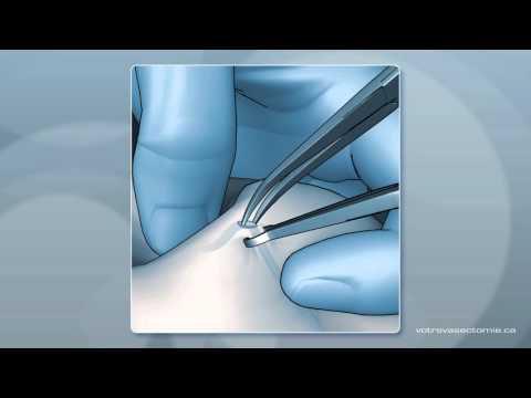 No scalpel vasectomy animation