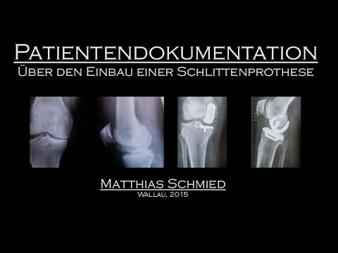 Osteoarthritis des Kniegelenks mit degenerativen Veränderungen des Meniskus Bewegungstherapie für Rückenschmerzen