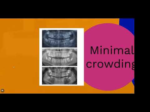 INTERCEPTIVE ORTHODONTICS :Extractions Guidelines of First Parmanent Molars.