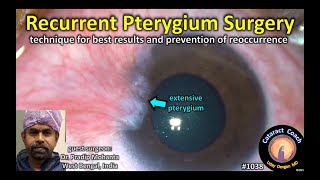 CataractCoach 1038: recurrent pterygium surgery