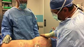 Brazilian Butt Lift Surgery in One Minute