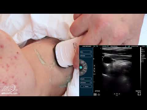 Ecografia Arteria Carotide DX - Ecografo palmare Wireless CERBERO4.0 B-MatrixSound