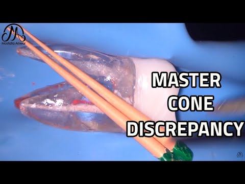 Master Cone Discrepancy - Fitting The Gutta Percha Master Cone | EndoTactics
