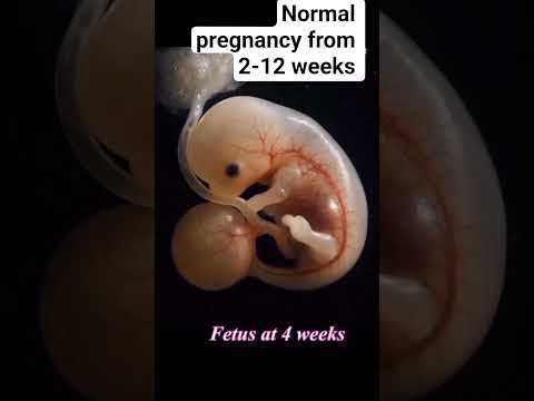Normal pregnancy from 2-12 weeks #radiology #pregnant #ultrasound #pregnancyscan #baby