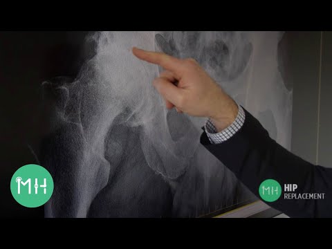 What is hip arthritis?