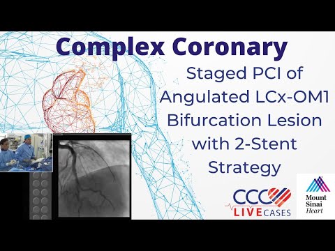 Staged PCI of Angulated LCx-OM1 Bifurcation Lesion with 2-Stent Strategy - CCC Live Feb 2017