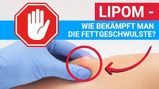 Lipom - wie bekämpft man die Fettgeschwulste?