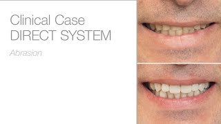 Patient experience with edelweiss system / before & after