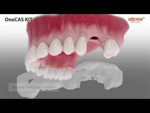 OneCAS KIT OneGuide System for Sinus Lift Surgery