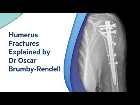 Humerus Fractures - Explained by Adelaide Orthopaedic Surgeon, Dr Oscar Brumby-Rendell