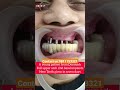 Basal Implants In 7 Days New Teeth To A Denmark Patient ऊपर के पूरे नए दा�
