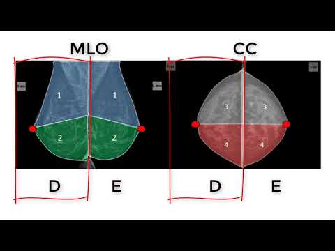 Fundamentos da mamografia. O que todo médico deve saber!