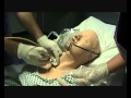 Tracheostomy Tube Change Using A Bougie