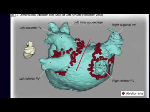 Risks and complications of atrial fibrillation ablation.