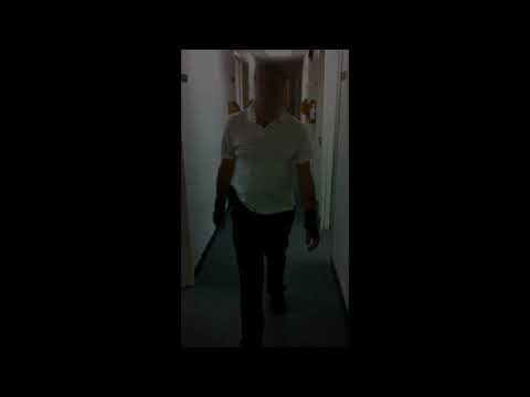 Endovascular treatment of a spinal dural arteriovenous malformation DAVF