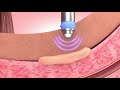 Peyronie S Disease Treatment Animation