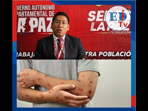 La Paz: confirman aumento de casos de sarampión en Ixiamas