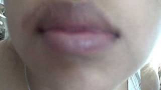 It’s Day 3 and my lip is still swollen but it’s getting better. Lip is healing nicely.