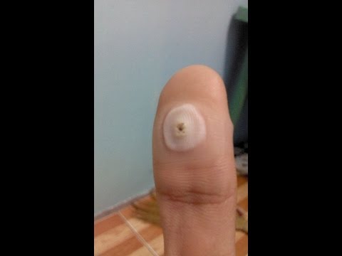 Ano ang isang magandang unguento ng halamang-singaw sa kanyang mga kamay Methenamine paggamot ng kuko halamang-singaw