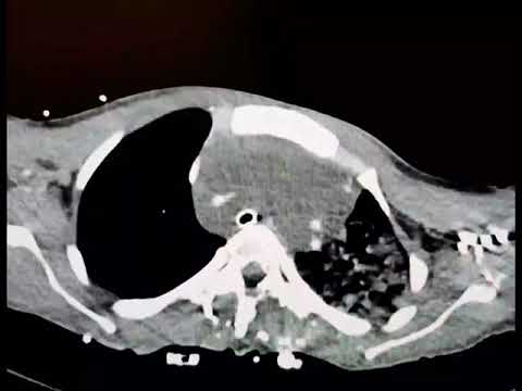 Myxoid Liposarcoma CT Scan