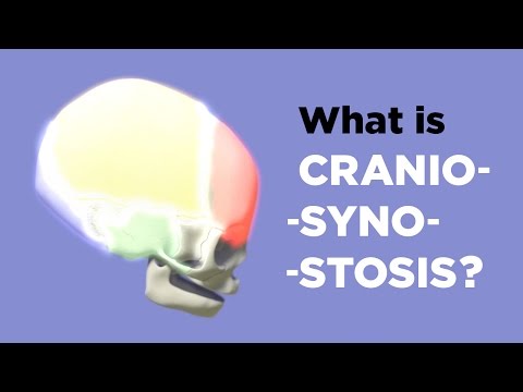 What is Craniosynostosis?