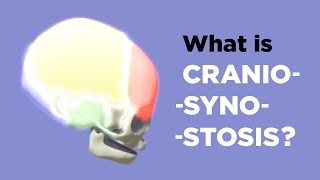 What is Craniosynostosis