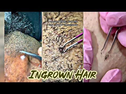 Removing Ingrown Hair Compilation | Body Care...