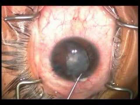 Cataract Surgery -  Milky White Cataract