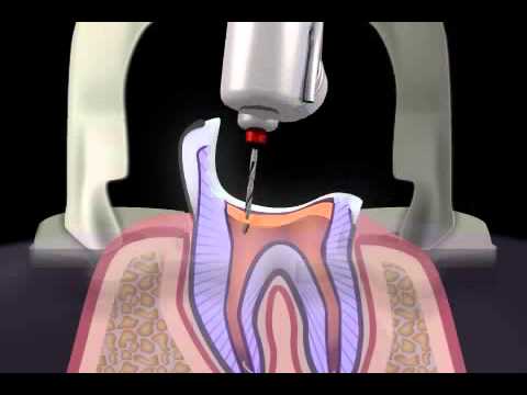 wie baut man einen abgebrochenen Zahn auf - Stumpfaufbau
