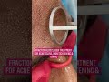 FractionalCO2laser Treatment For Acne Scars Dermatologist Skin Tightening Chandigarh Shorts