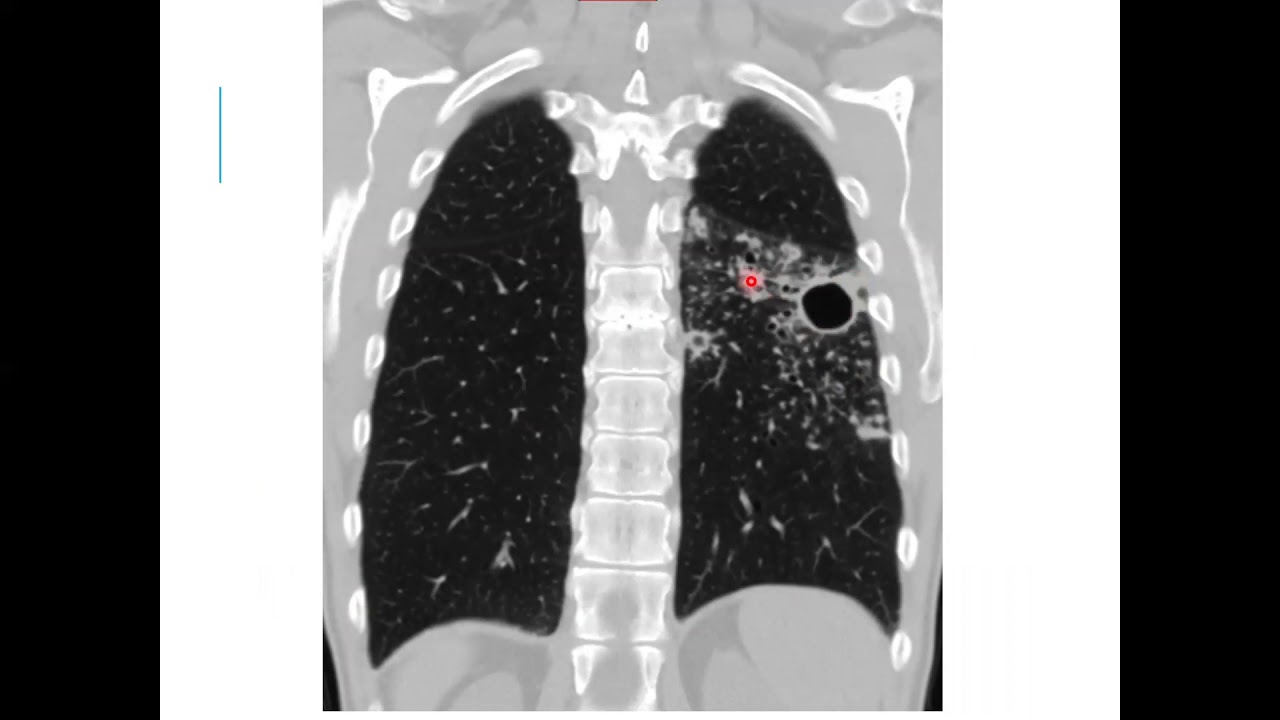 Hallazgos radiológicos y tomograficos de Tuberculosis