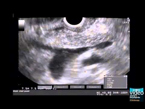 Diagnosis of Pancreas Divisum Using Linear-Array Endosonography