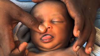 Newborn Care Series: Jaundice