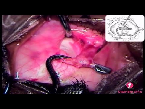 Surgeries for Small Angle Strabismus