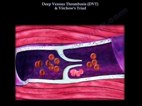 Tiefe Venenthrombose