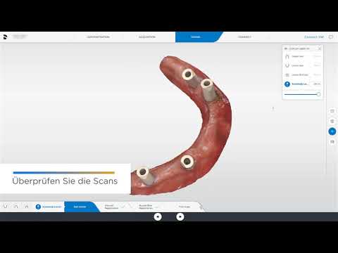Workflow von Connect Case Center Inbox zu exocad für einen Implantatfall (All-on-4): Implantat