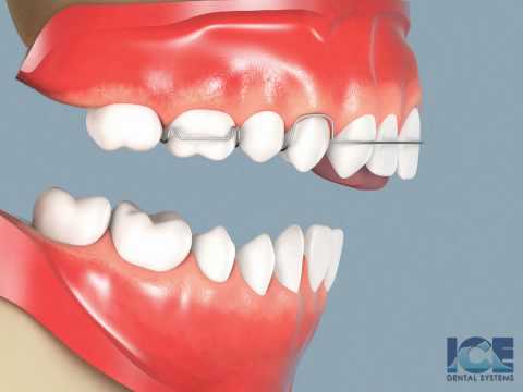 Anterior Openbite with Appliance