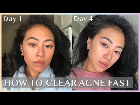 HOW I GET RID OF ACNE – in 4 days! W/ PHOTOS Video