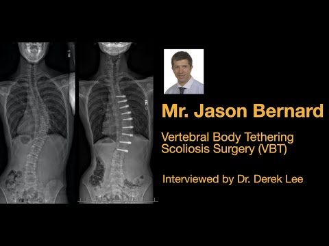 Mr. Jason Bernard, MD, Vertebral Body Tethering (VBT) Scoliosis Surgery interviewed by Dr. Derek Lee