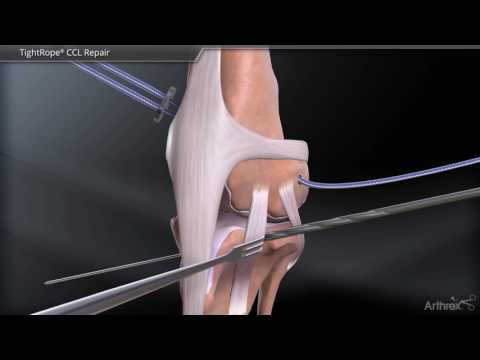 TightRope® CCL Repair - YouTube