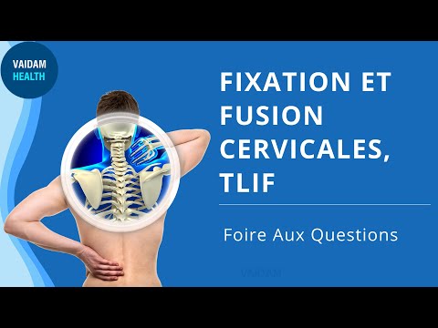 FIXATION ET FUSION CERVICALES, TLIF - Foire Aux Questions