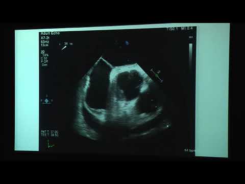 20180824_32_ TEE_for_aortic_dissection_ Jacob_Hutchins_Dr