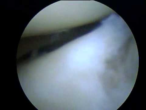 Colonna vertebrale e le articolazioni profilassi trattamento Alterazioni ossee a osteocondrosi vertebrale