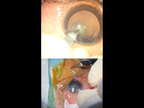 Aprenda a série Phaco Basics - Para o novato - Como fazer incisões perfeitas na porta principal e na porta lateral